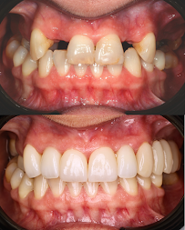 Warsaw Dental Academy Implanty Licówki Bonding