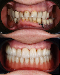 Warsaw Dental Academy Implanty Licówki Bonding
