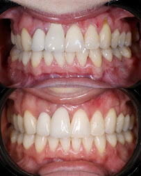 Warsaw Dental Academy Implanty Licówki Bonding