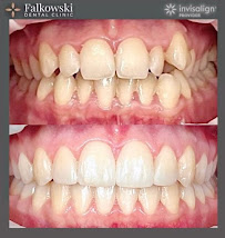 Falkowski Dental Clinic Warszawa Ortodoncja - Invisalign