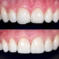 Falkowski Dental Clinic Warszawa Ortodoncja - Invisalign