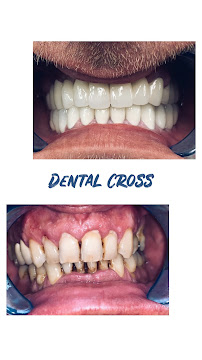 Dental Cross