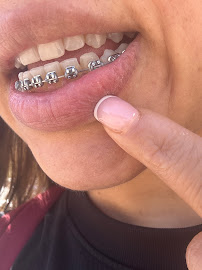 implantes dentales en valencia