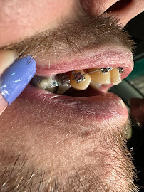 implantes dentales en valencia