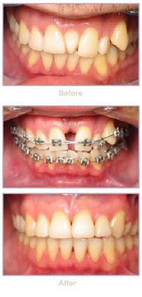 Clinica Dental Incilex Valencia - Dentistas y Especialistas en Implantologia y Ortodoncia, Dientes fijos en 1 dia