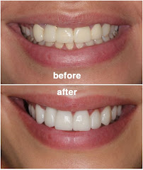 Clinica Dental Incilex Valencia - Dentistas y Especialistas en Implantologia y Ortodoncia, Dientes fijos en 1 dia