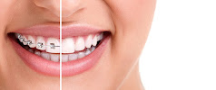 Clinica Dental Incilex Valencia - Dentistas y Especialistas en Implantologia y Ortodoncia, Dientes fijos en 1 dia