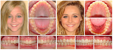 Clinica Dental Incilex Valencia - Dentistas y Especialistas en Implantologia y Ortodoncia, Dientes fijos en 1 dia