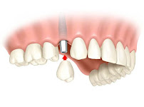Clinica Dental Crooke Marbella