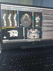 Rehabilitación Dental dentista Cancún endodoncia implantes prótesis fija
