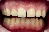 Mandarindent - Bodrum Diş Kliniği – Diş Tedavileri – Diş İmplantı – Estetik Diş Hekimliği