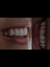Diseño de sonrisa / Dental Experience / Blanqueamiento dental/ implantes Dentales
