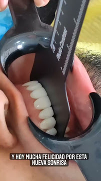 Diseño de sonrisa / Dental Experience / Blanqueamiento dental/ implantes Dentales