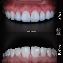 Diseño de sonrisa / Dental Experience / Blanqueamiento dental/ implantes Dentales