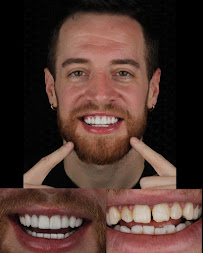 Diseño de sonrisa / Dental Experience / Blanqueamiento dental/ implantes Dentales