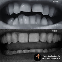 Diseño de sonrisa / Dental Experience / Blanqueamiento dental/ implantes Dentales