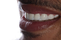 Diseño de sonrisa / Dental Experience / Blanqueamiento dental/ implantes Dentales