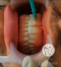 Diseño de sonrisa / Dental Experience / Blanqueamiento dental/ implantes Dentales