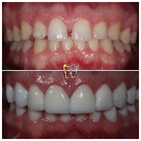 Diseño de sonrisa / Dental Experience / Blanqueamiento dental/ implantes Dentales
