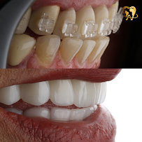 Diseño de sonrisa / Dental Experience / Blanqueamiento dental/ implantes Dentales