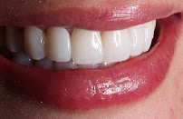Doctora Veronica Diseño de Sonrisa en Bogotá Carillas de Porcelana Implantes Dentales Ortodoncia Invisalign