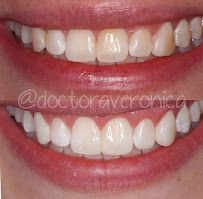 Doctora Veronica Diseño de Sonrisa en Bogotá Carillas de Porcelana Implantes Dentales Ortodoncia Invisalign