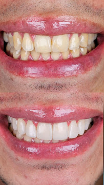 Doctora Veronica Diseño de Sonrisa en Bogotá Carillas de Porcelana Implantes Dentales Ortodoncia Invisalign