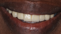 Dental Tourism Colombia (Cartagena, Dr. Julio Oliver)