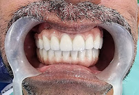 Dental Tourism Colombia (Cartagena, Dr. Julio Oliver)