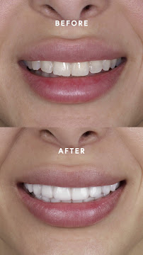 Sonrisa Italiana - Daniel Zabaleta - Porcelain Veneers