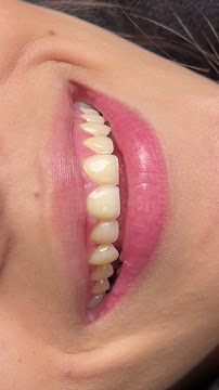 Sonrisa Italiana - Daniel Zabaleta - Porcelain Veneers
