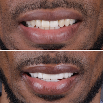 Sonrisa Italiana - Daniel Zabaleta - Porcelain Veneers