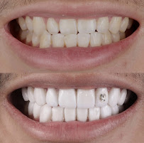Sonrisa Italiana - Daniel Zabaleta - Porcelain Veneers