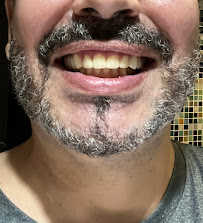 Sonrisa Italiana - Daniel Zabaleta - Porcelain Veneers