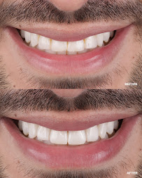 Sonrisa Italiana - Daniel Zabaleta - Porcelain Veneers