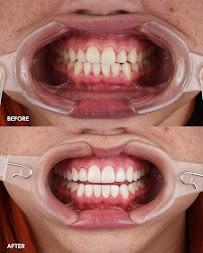 Sonrisa Italiana - Daniel Zabaleta - Porcelain Veneers