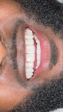 Sonrisa Italiana - Daniel Zabaleta - Porcelain Veneers