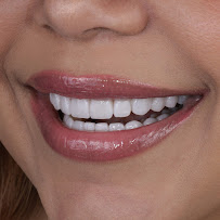 Sonrisa Italiana - Daniel Zabaleta - Porcelain Veneers