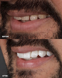 Sonrisa Italiana - Daniel Zabaleta - Porcelain Veneers