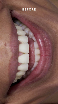 Sonrisa Italiana - Daniel Zabaleta - Porcelain Veneers
