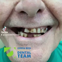 Costa Rica Dental Team - Dental Implants