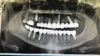 Costa Rica Dental Team - Dental Implants