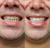 Teeth Whitening Melbourne