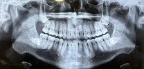 X-Dentistry In Tijuana