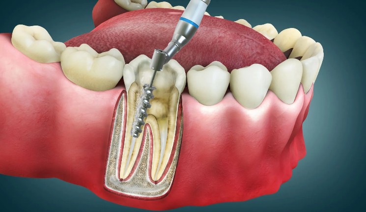 Aura Dental Centre - dental clinic in Hervey Bay, Australia