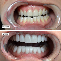 DR MEXICO/Tijuana Dentist, All on 4 Dental Implants