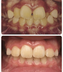 One Odontologia Moema - Invisalign em Moema
