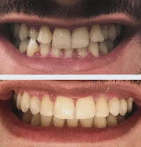 One Odontologia Moema - Invisalign em Moema