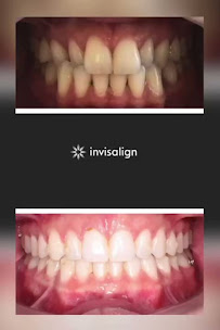 One Odontologia Moema - Invisalign em Moema