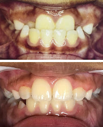 One Odontologia Moema - Invisalign em Moema